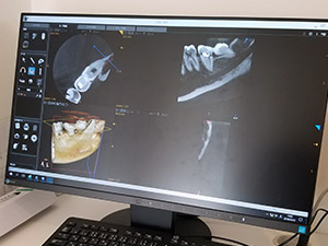歯科用ＣＴ　３Ｄ画像診断装置